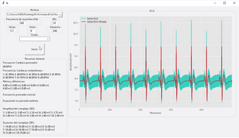 Extraction of parameters from electrocardiographic signals